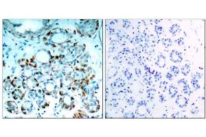 Immunohistochemical analysis of paraffin-embedded human breast carcinoma tissue, using BIM (phospho-Ser65) antibody (E011288). (BIM Antikörper  (pSer65, pSer69))