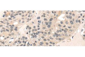 Immunohistochemistry of paraffin-embedded Human breast cancer using MED28 Polyclonal Antibody at dilution of 1/30 (MED28 Antikörper)