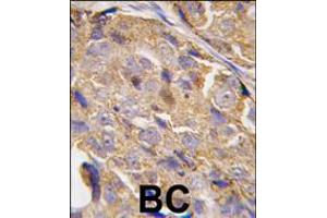 Formalin-fixed and paraffin-embedded human breast carcinoma tissue reacted with EIF4B-S422, which was peroxidase-conjugated to the secondary antibody, followed by DAB staining. (EIF4B Antikörper  (AA 400-429))