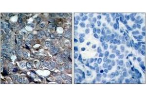 Immunohistochemistry analysis of paraffin-embedded human breast carcinoma, using ASK1 (Phospho-Ser83) Antibody. (ASK1 Antikörper  (pSer83))