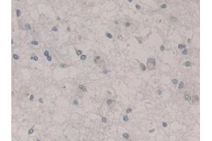 DAB staining on IHC-P; Samples: Human Glioma Tissue (Nestin Antikörper  (AA 178-399))