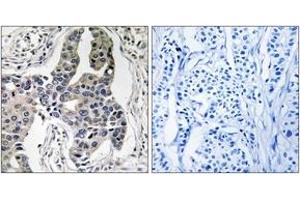 Immunohistochemistry analysis of paraffin-embedded human breast carcinoma, using Vimentin (Phospho-Ser83) Antibody. (Vimentin Antikörper  (pSer83))