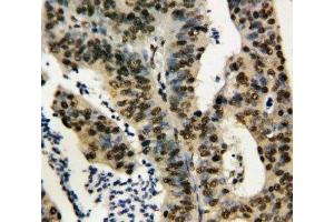 IHC-P: TNFAIP1 antibody testing of human rectal cancer tissue (TNFAIP1 Antikörper  (N-Term))