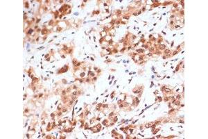 Immunohistochemistry of paraffin-embedded Human liver cancer using Phospho-STAT1(S727) Polyclonal Antibody at dilution of 1:100 (40x lens). (STAT1 Antikörper  (pSer727))