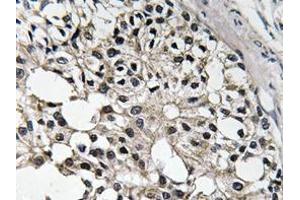 Immunohistochemistry analyzes of IRS-1 antibody in paraffin-embedded human breast carcinoma tissue. (IRS1 Antikörper)