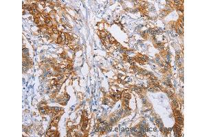 Immunohistochemistry of Human liver cancer using CA9 Polyclonal Antibody at dilution of 1:50 (CA9 Antikörper)
