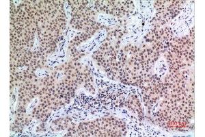 Immunohistochemistry (IHC) analysis of paraffin-embedded Human Mammary Cancer, antibody was diluted at 1:100. (P57 (Ser24) Antikörper)