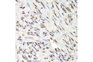 Immunohistochemistry of paraffin-embedded human adenomyosis using HNRNPD Antibody (ABIN5970929) at dilution of 1/100 (40x lens). (HNRNPD/AUF1 Antikörper)