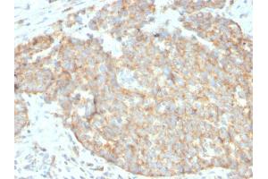 Formalin-fixed, paraffin-embedded human breast carcinoma stained with DR5 Mouse Monoclonal Antibody (DR5/3381). (TNFRSF10B Antikörper  (AA 266-393))