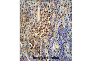 PUS3 antibody immunohistochemistry analysis in formalin fixed and paraffin embedded human lung carcinoma followed by peroxidase conjugation of the secondary antibody and DAB staining. (PUS3 Antikörper  (N-Term))