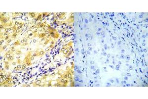 Immunohistochemical analysis of paraffin- embedded human lung carcinoma tissue using P53 (Ab-37) antibody (E022031). (p53 Antikörper)