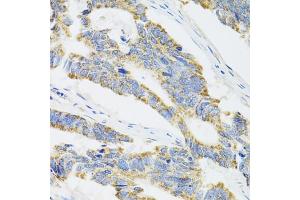Immunohistochemistry of paraffin-embedded human colon carcinoma using CYP1A1 antibody. (CYP1A1 Antikörper)
