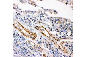 Anti- IKK beta antibody,IHC(P) IHC(P): Human Lung Cancer Tissue (IKBKB Antikörper  (AA 398-756))