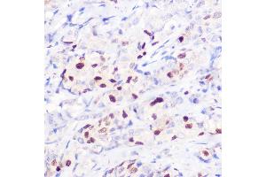 Immunohistochemistry of paraffin-embedded human breast cancer using [KO Validated] CDKN1A/p21CIP1 Rabbit pAb (ABIN1679159, ABIN1679158, ABIN3016472 and ABIN6219758) at dilution of 1:100 (40x lens). (p21 Antikörper  (AA 1-164))