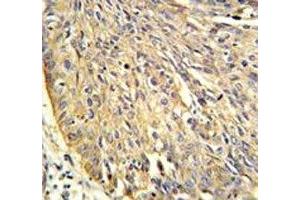 Annexin A1 antibody IHC analysis in formalin fixed and paraffin embedded human lung carcinoma. (Annexin a1 Antikörper  (AA 129-158))