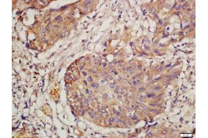 Formalin-fixed and paraffin embedded human lung carcinoma labeled with Rabbit Anti-CD44 Polyclonal Antibody, Unconjugated  at 1:200 followed by conjugation to the secondary antibody and DAB staining (CD44 Antikörper  (AA 231-330))