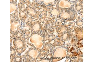 Immunohistochemistry of Human thyroid cancer using EVA1A Polyclonal Antibody at dilution of 1:30 (TMEM166 Antikörper)