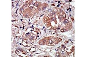 IHC analysis of FFPE human hepatocarcinoma stained with the PRKR antibody (EIF2AK2 Antikörper  (AA 519-550))