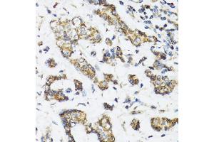 Immunohistochemistry of paraffin-embedded human breast cancer using DHRS2 antibody (ABIN5973846) at dilution of 1/100 (40x lens). (DHRS2 Antikörper)