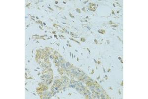 Immunohistochemistry of paraffin-embedded human breast cancer using MTFP1 antibody (ABIN5975088) at dilution of 1/100 (40x lens). (Mtfp1 Antikörper)