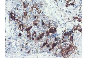 Immunohistochemical staining of paraffin-embedded Adenocarcinoma of Human breast tissue using anti-SERPINB2 mouse monoclonal antibody. (SERPINB2 Antikörper)