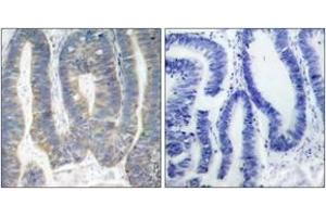 Immunohistochemistry analysis of paraffin-embedded human colon carcinoma, using PKR (Ab-451) Antibody. (EIF2AK2 Antikörper  (AA 418-467))