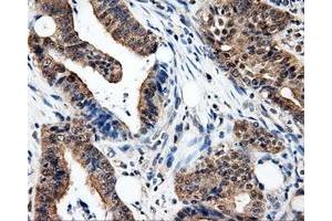 Immunohistochemical staining of paraffin-embedded Adenocarcinoma of colon tissue using anti-PSMC3 mouse monoclonal antibody. (PSMC3 Antikörper)