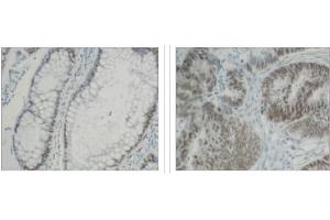 Immunohistochemical staining of  normal colon (left) and colon carninoma (center) using hnRNP-K antibody . (HNRNPK Antikörper  (C-Term))