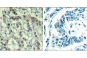 Immunohistochemical analysis of paraffin-embedded human breast carcinoma tissue using AuroraA (phospho-Thr288) Antibody (E011519). (Aurora A Antikörper  (pThr288))