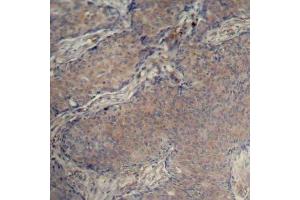 Immunohistochemistry of paraffin-embedded human breast carcinoma using Phospho-MYL12A-S18 antibody (ABIN2988196). (MYL12A Antikörper  (pSer18))
