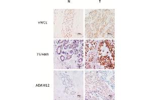 Representative IHC of non-neoplastic (N) and triple-negative breast cancer (T) tissues of VWCE, TSPAN9 and ADAM12 proteins. (ADAM12 Antikörper  (AA 589-738))