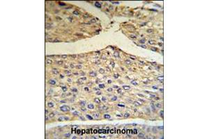 BF Antibody IHC analysis in formalin fixed and paraffin embedded human hepatocarcinoma tissue followed by peroxidase conjugation of the secondary antibody and DAB staining. (Complement Factor B Antikörper  (AA 395-422))