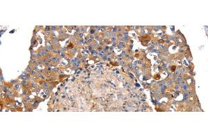Immunohistochemistry of paraffin-embedded Human breast cancer tissue using IRS2 Polyclonal Antibody at dilution 1:100 (IRS2 Antikörper)