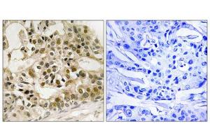 Immunohistochemistry analysis of paraffin-embedded human breast carcinoma tissue using Myb (Phospho-Ser532) antibody. (MYB Antikörper  (pSer532))
