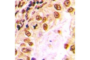 Immunohistochemical analysis of Nibrin staining in human lung cancer formalin fixed paraffin embedded tissue section. (Nibrin Antikörper)
