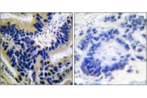 Immunohistochemistry analysis of paraffin-embedded human lung carcinoma, using Caspase 3 (Cleaved-Asp175) Antibody. (Caspase 3 Antikörper  (Cleaved-Asp175))