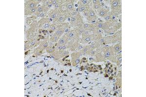 Immunohistochemistry of paraffin-embedded human liver injury using S100A12 antibody (ABIN5973068) at dilution of 1/100 (40x lens). (S100A12 Antikörper)