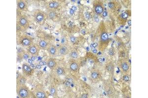 Immunohistochemistry of paraffin-embedded Human liver damage using TLK2 Polyclonal Antibody at dilution of 1:100 (40x lens). (TLK2 Antikörper)