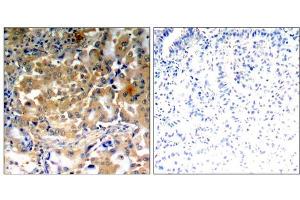 Immunohistochemical analysis of paraffin-embedded human lung carcinoma tissue using PKCζ (Phospho-Thr410) antibody (E011314). (PKC zeta Antikörper  (pThr410))