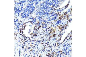 Immunohistochemistry of paraffin-embedded human lung cancer using CD9 Rabbit mAb (ABIN7266227) at dilution of 1:100 (40x lens). (CD9 Antikörper)