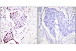 Immunohistochemistry analysis of paraffin-embedded human breast carcinoma tissue, using Ubiquitin Antibody. (Ubiquitin Antikörper  (AA 40-89))