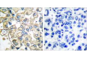 Peptide - +Immunohistochemical analysis of paraffin-embedded human breast carcinoma tissue using FGFR1 Oncogene Partner antibody (#C0190). (FGFR1OP Antikörper)