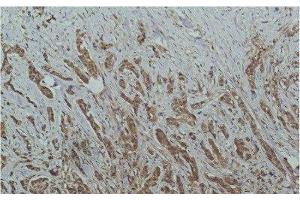 Immunohistochemistry of paraffin-embedded Human breast carcinoma tissue using HDAC1 Monoclonal Antibody at dilution of 1:200. (HDAC1 Antikörper)