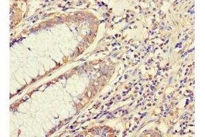 Immunohistochemistry of paraffin-embedded human colon cancer using ABIN7145091 at dilution of 1:100 (ATG5 Antikörper  (AA 5-272))