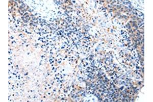 The image on the left is immunohistochemistry of paraffin-embedded Human esophagus cancer tissue using ABIN7190332(COLEC12 Antibody) at dilution 1/40, on the right is treated with synthetic peptide. (COLEC12 Antikörper)