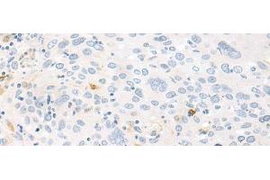 Immunohistochemistry of paraffin-embedded Human cervical cancer tissue using FABP4 Polyclonal Antibody at dilution of 1:60(x200) (FABP4 Antikörper)