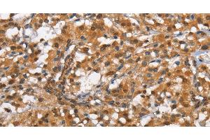 Immunohistochemistry of paraffin-embedded Human thyroid cancer tissue using CD13 Polyclonal Antibody at dilution 1:80 (CD13 Antikörper)