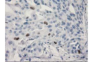 Immunohistochemical staining of paraffin-embedded Carcinoma of Human bladder tissue using anti-TP53 mouse monoclonal antibody. (p53 Antikörper)