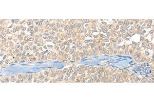 Immunohistochemistry of paraffin-embedded Human ovarian cancer tissue using SNX6 Polyclonal Antibody at dilution of 1:40(x200) (SNX6 Antikörper)