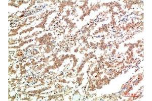 Immunohistochemical analysis of paraffin-embedded Human Lung Carcinoma Tissue using JAK2 Mouse mAb diluted at 1:200. (JAK2 Antikörper)